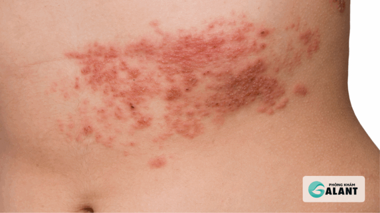 tái phát herpes sinh dục