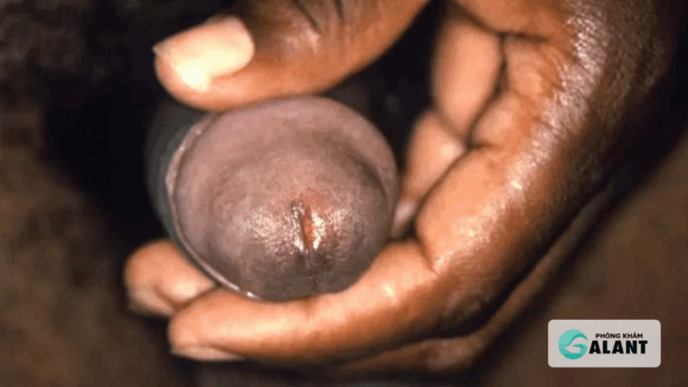 Triệu chứng lậu ở nam giới