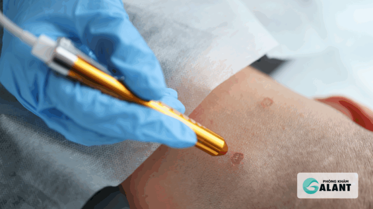 điều trị sùi mào gà bằng laze