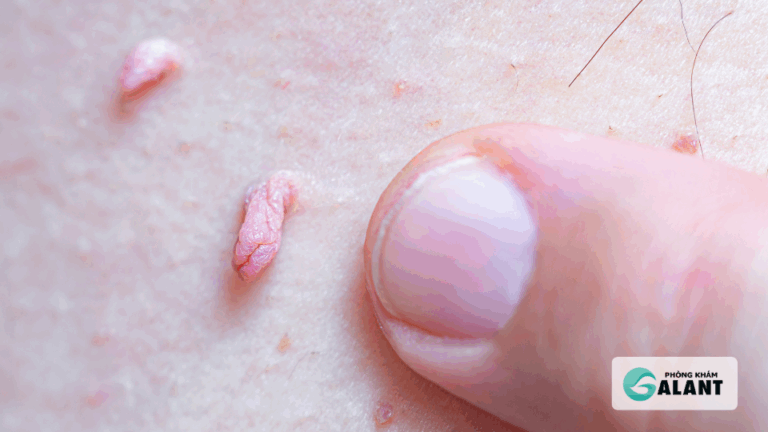 Phòng ngừa sùi mào gà