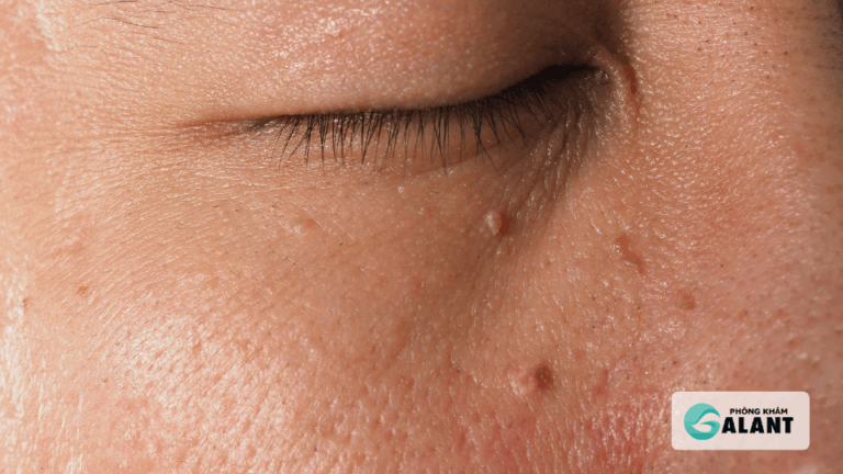 Triệu chứng sùi mào gà