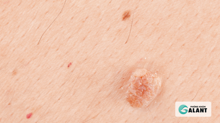 dấu hiệu sùi mào gà chung